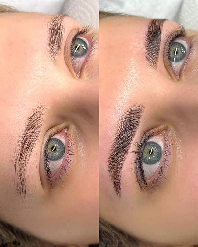 Brow Lifting vorher nachher